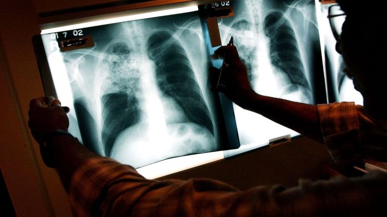 California tuberculosis outbreak kills 1, infects 14 as officials declare health emergency