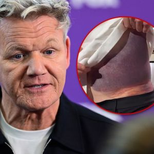 gordon ramsay bruise main getty comp