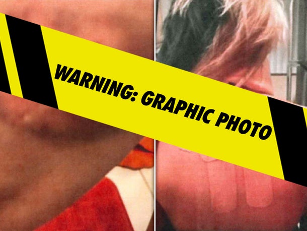 P Diddy Court Exhibits - Bryana Bongolan's Injuries