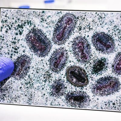 First clade I mpox case confirmed in Connecticut after patient traveled to Western Europe