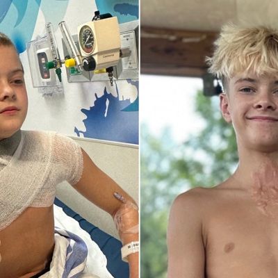 Microwaved squishy toy explodes onto boy's face and chest amid viral trend, causing horrific burns